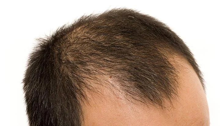 Is Male Pattern Baldness Less Common in Native Americans?